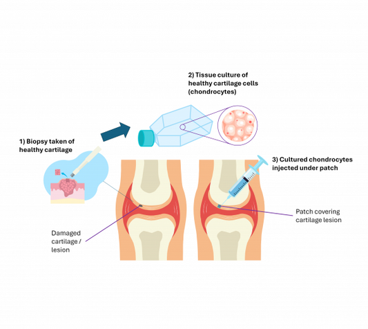 Cell Therapy for Early Osteoarthritis: Pain & Function