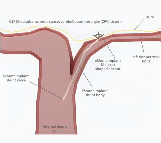 New Minimally Invasive Treatment for NPH