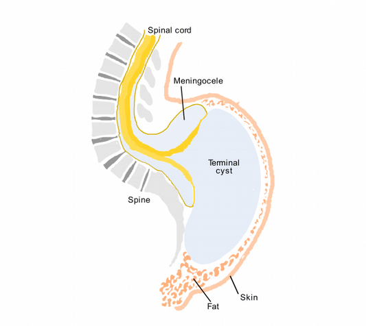 Insights into Closed Spinal Dysraphism and Myelocystocele