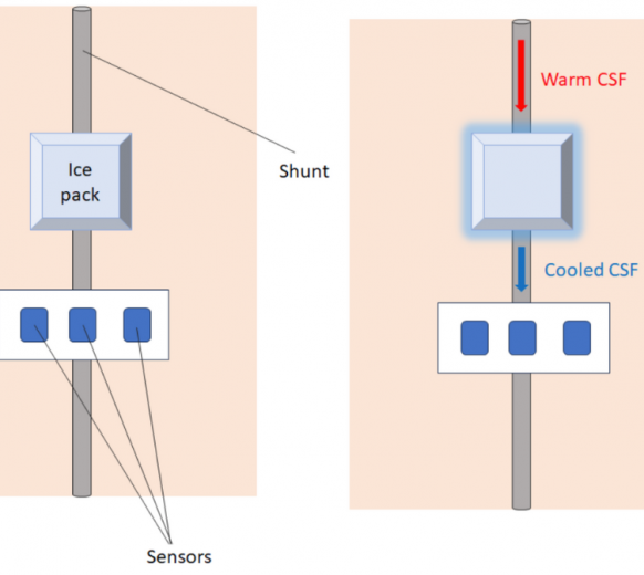Non-invasive diagnostic device to detect shunt malfunction