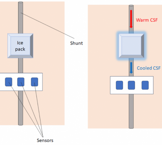 Non-invasive diagnostic device to detect shunt malfunction